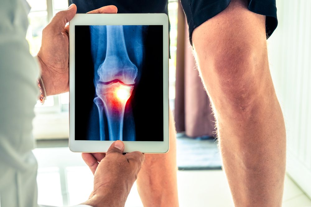 Osteoarthrose: Ursachen, Symptome und Prävention